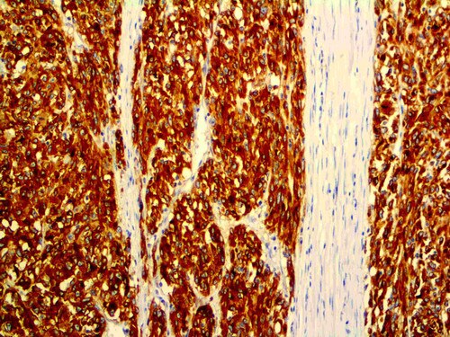 IHC of DOG-1 on an FFPE GIST Tissue